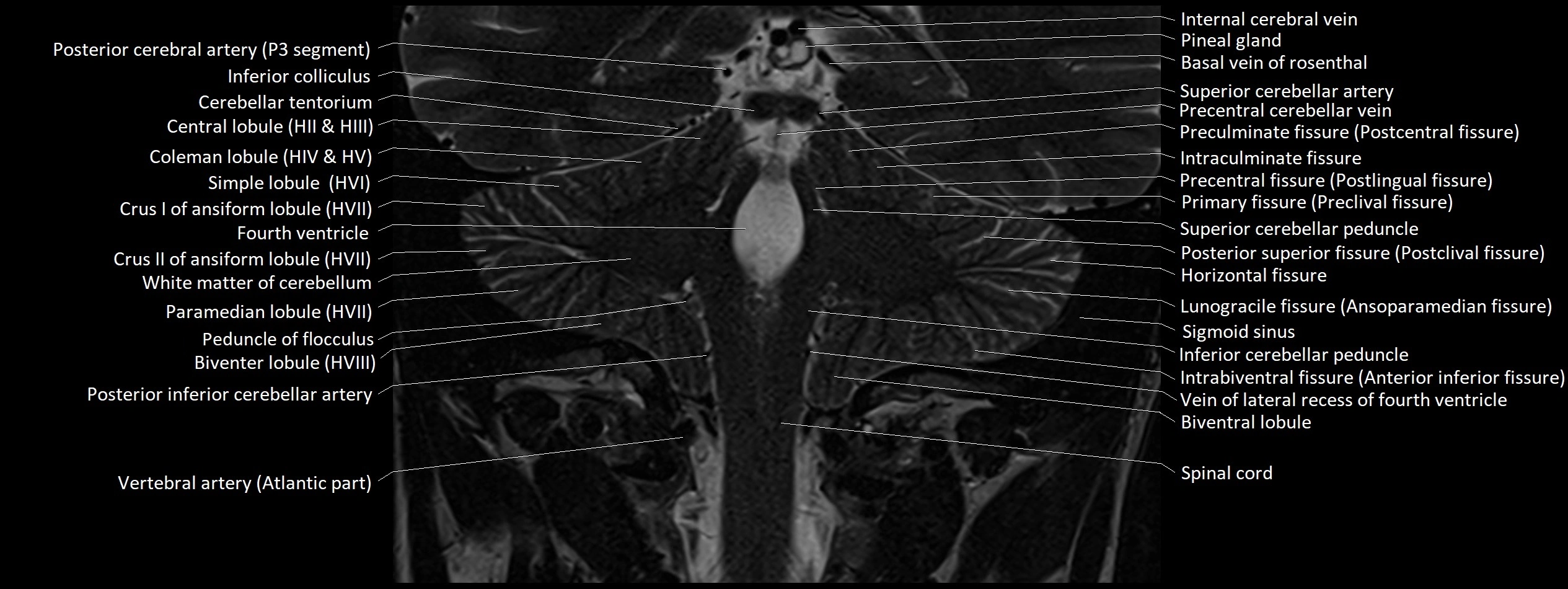 Anatomy of cerebellum coronal cross sectional 3T image 8.webp